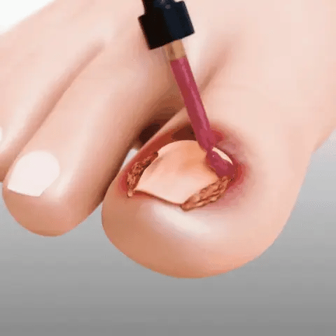 FungiClear™ – Nagelreparaturserum