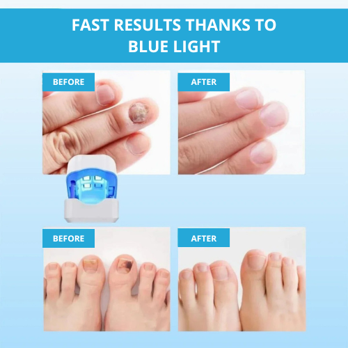 LaserNail Pro | Behandlung gegen Pilz